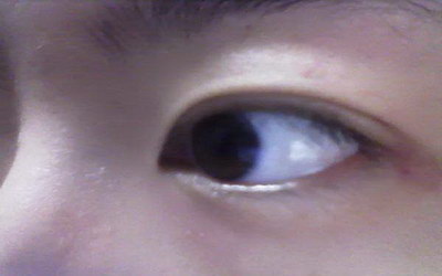 眼睛周围受伤肿了怎么快速消除(眼睛周围受伤的人命好不好)