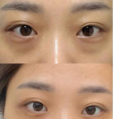 孕妇眼角疼痛能用什么药_怎么去额头皱纹和眼角皱纹最有效