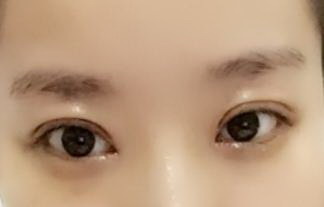 黑眼圈严重眼干涩怎么办(眼部黑眼圈严重怎么办)