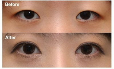 单眼皮和内双的正为贴双眼皮mm们双眼皮贴的危害？