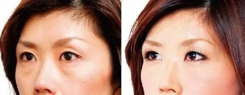 孕妇可以割双眼皮手术吗(孕妇可以进行双眼皮手术吗？)