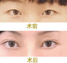 北京哪里做双眼皮修复(北京双眼皮修复哪里做的好)