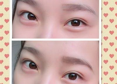 全切双眼皮包括眼尾提升吗