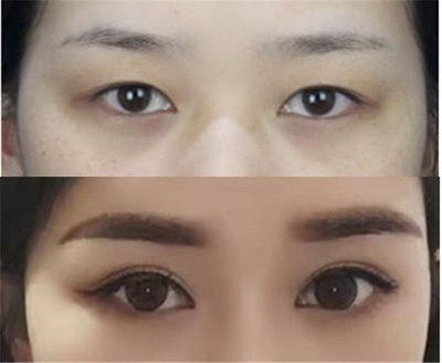 眼肌型重症无力治疗指南(眼肌型重症无力医院治疗)