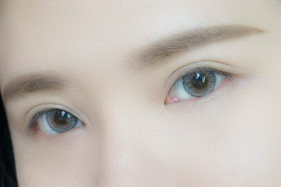 开眼角手术疤痕怎么去掉