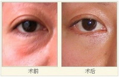 眼角疼痛红肿是怎么回事_眼角周围细纹如何解决