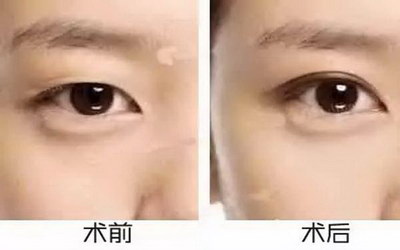 郑州哪个医院开眼角好