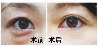 开眼角哪种方法比较好_开眼角哪种方法最好