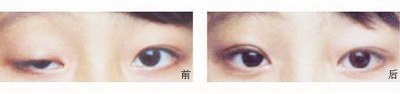 开眼角手术真的能使眼睛变大吗[开眼角手术真的能让眼睛变大吗]