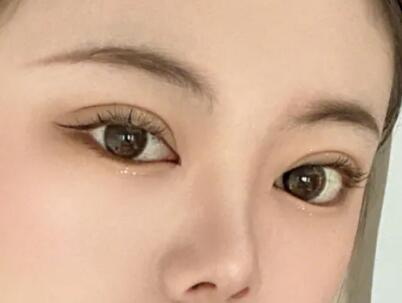 双眼皮第二天换药是怎么换(双眼皮换药第二天怎么换)