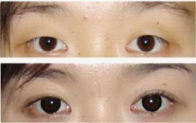自体脂肪填充眼窝需要多长时间[自体脂肪填充眼窝能保持多长时间]