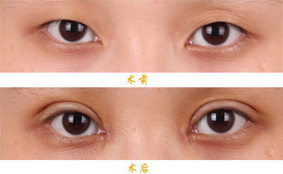 40岁的女人怎么消除眼袋(女人怎么样才能消除眼袋)