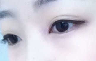 无锡双眼皮方法(无锡割双眼皮方法)
