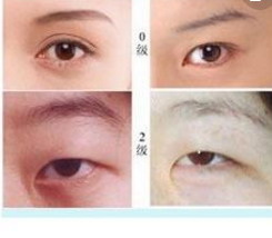 治疗眼睛需要多少钱