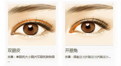 双眼皮手术什么时候做(双眼皮手术什么时候开始抬眼练习)