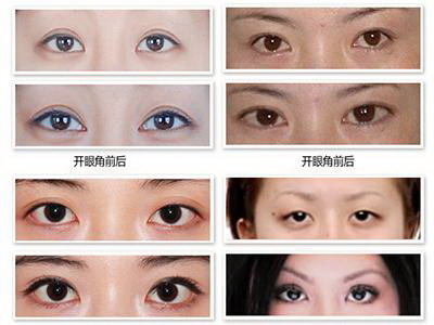 全切双眼皮做宽了怎么处理【全切双眼皮留疤怎么处理】