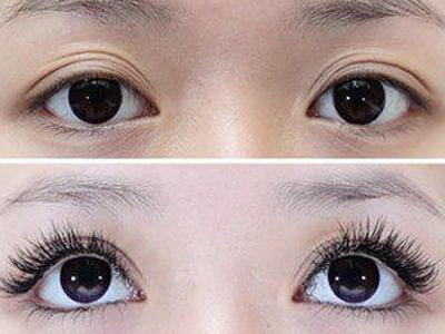 眼睛浮肿怎么消除小妙招(眼睛浮肿有眼袋怎么消除)