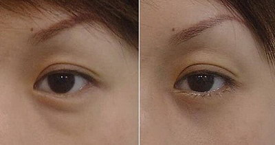哈尔滨哪个医生修复双眼皮好(哈尔滨哪个医生割双眼皮好)