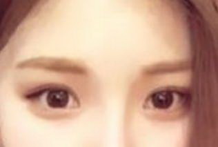 重眼睑手术是什么_出现眼睑松弛怎么办