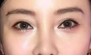 做完双眼皮20天了怎么还有点红呢