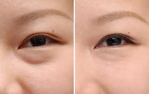 欧式双眼皮的手术有怎样的优点及适合怎样的人群
