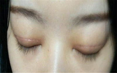 全切双眼皮和埋线双眼皮的区别(埋线全切双眼皮的区别)