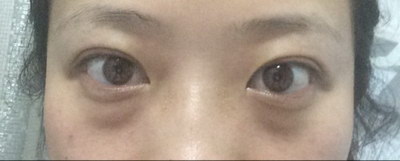 割眼袋后需要注意些什么