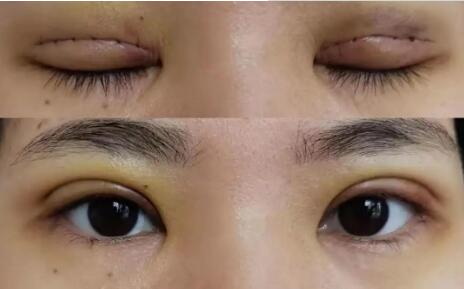 双眼皮拆线后可以用蒸汽眼罩吗(双眼皮拆线后多久可以用蒸汽眼罩消肿)
