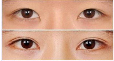 双眼皮手术怎么算失败【双眼皮手术失败了怎么处理】