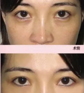 成都无痕做双眼皮(成都日本无痕双眼皮)