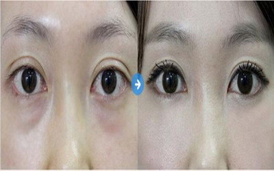 来月经能做全切双眼皮吗(来月经了可以做全切双眼皮吗)