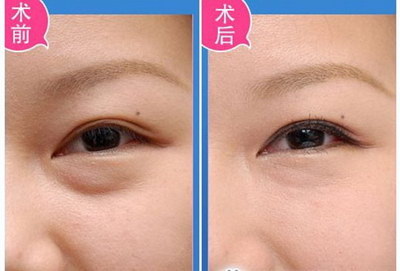 你必须知道的开眼角手术的宜与不宜