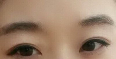 眼部肌无力可以晒太阳吗(眼部肌无力患者能晒太阳吗？)