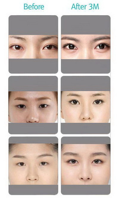 埋线双眼皮修复是什么意思(埋线双眼皮什么时候能修复)