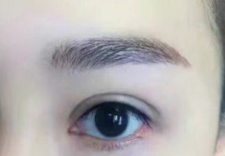 埋线双眼皮的持续时间有多长？