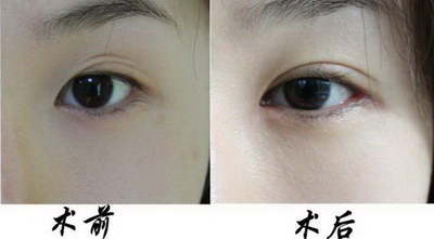 自然款双眼皮是什么样的(什么样式双眼皮最自然)