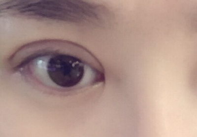 下眼袋发红是什么原因引起的