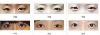 双眼皮第五天了有点痒怎么办