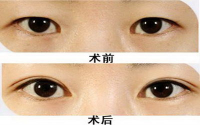 梅州眼角斑_提眉能减少眼角皱纹吗