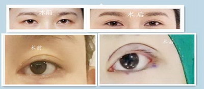 眼部美容整形试题及答案_眼部抗衰老的几个方法