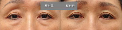 眼部术后注意事项_眼部提升最好的方法