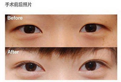 去眼袋手术后会有哪些后遗症
