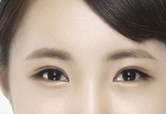 福州美莱双眼皮(福州美莱割双眼皮)