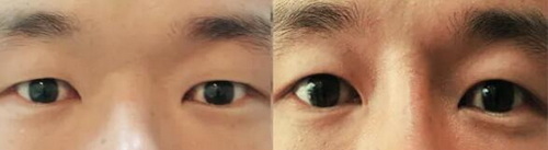 埋线双眼皮多少钱啊？