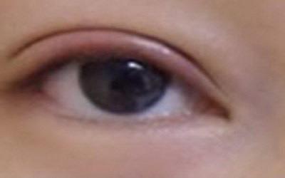 我的眼袋很重怎么办_20岁眼袋很重怎么办