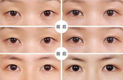 小眼开大哪家效果好[九江小眼开大哪家医院做效果最好]
