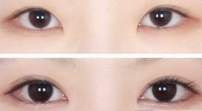 双眼皮术后吃什么消肿最快(双眼皮术后快速消肿吃什么)