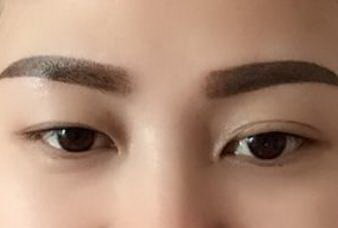韩国双眼皮修复医院:出色的效果完美呈现(韩国双眼皮修复DH医院)