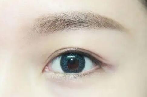 双眼皮术的修复术好不好呢？
