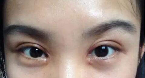 怎么样除去黑眼圈的办法(怎么样除去黑眼圈办法)